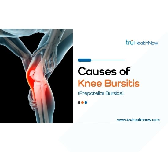 Causes of Knee Bursitis (Prepatellar Bursitis) trüHealthNow